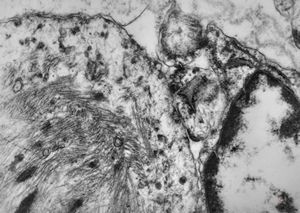 M,3m. | rhabdomyosarcoma in retented testis